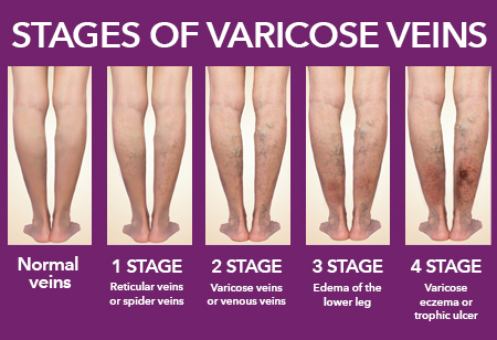 Top four signs you may need to see a vascular specialist | HonorHealth