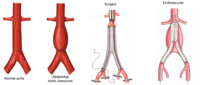 Aortic aneurysm surgery diagrams