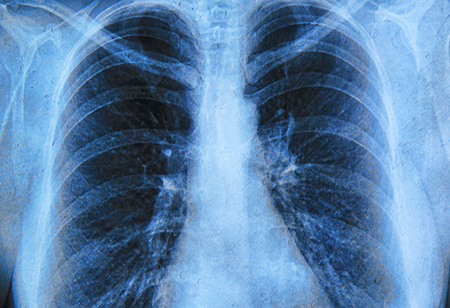 Smokers Lungs Vs Healthy Lungs Know The Difference